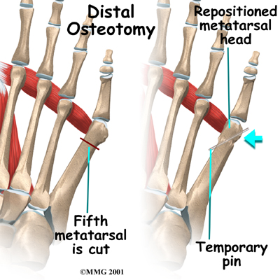 foot_bunionette_surgery02
