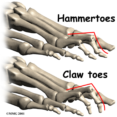 foot_clawtoes_anat03