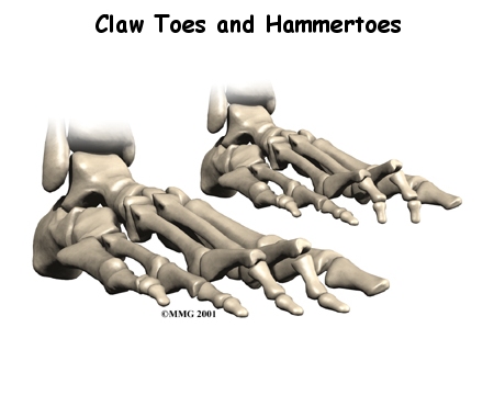 foot_clawtoes_intro01