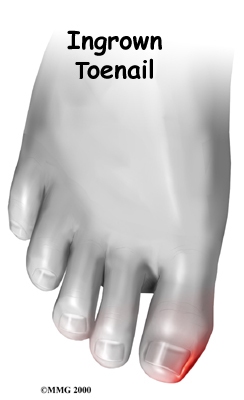 foot_ingrown_toenail_intro01
