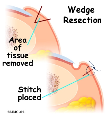 foot_ingrown_toenail_treatment02