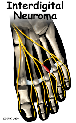 foot_neuroma_intro01