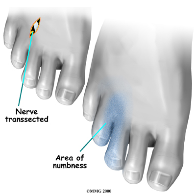 foot_neuroma_surgery01