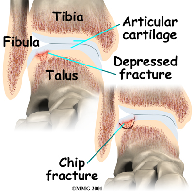foot_osteochondritis_dissecans_causes01