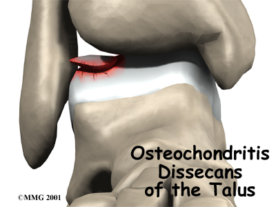 foot_osteochondritis_dissecans_intro01