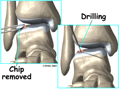 foot_osteochondritis_dissecans_surgery01