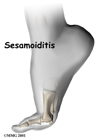 foot_sesamoiditis_intro01
