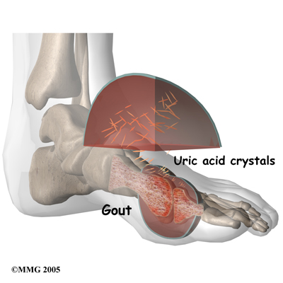 general_gout_intro01