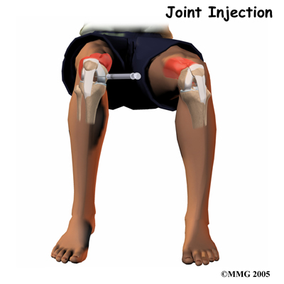 general_prp_knee_inject