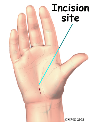 hand_carpal_tunnel_surgery01