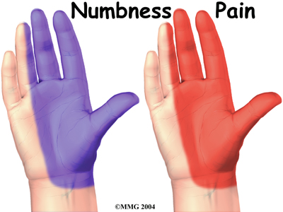 hand_carpal_tunnel_symptoms01