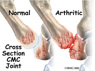 hand_cmc_arthroplasty_anat03