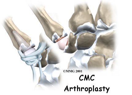 hand_cmc_arthroplasty_intro01
