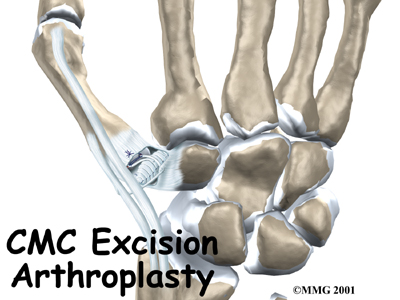 hand_cmc_excision_intro01