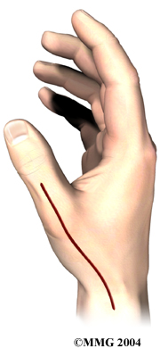 hand_cmc_excision_surg01
