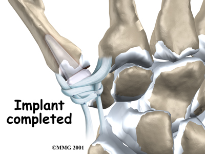 hand_cmc_treatment02