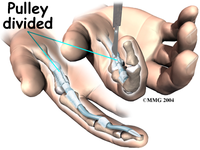 hand_trigger_digit_surgery01