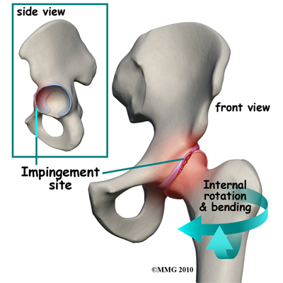 hip_FAI_causes01