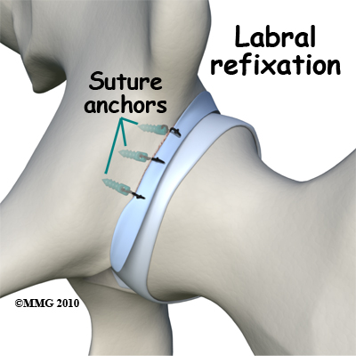 hip_FAI_labral_refixation
