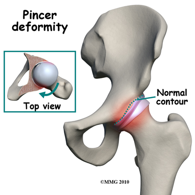 hip_FAI_pincer_deformity