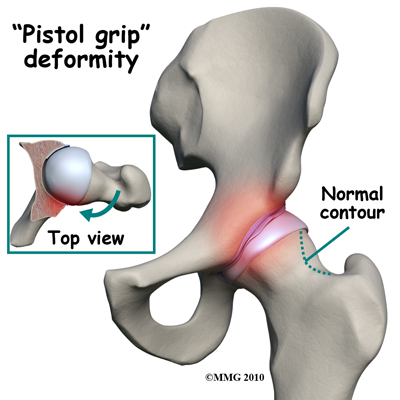 hip_FAI_pistol_grip_deformity