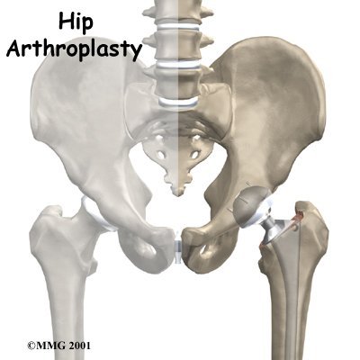 hip_arthroplasty_intro01