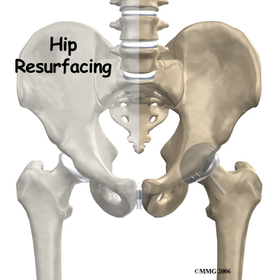 hip_arthroplasty_resurface_intro01