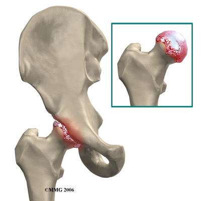 hip_arthroplasty_resurface_rationale01