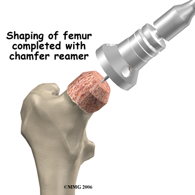 hip_arthroplasty_resurface_surgery05