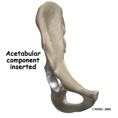 hip_arthroplasty_resurface_surgery08