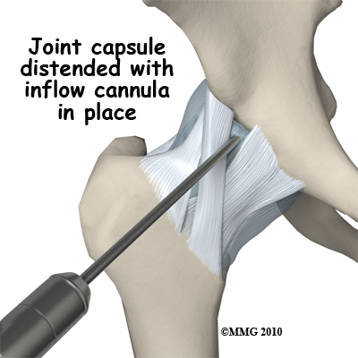 hip_arthroscopy_anatomy_joint_capsule