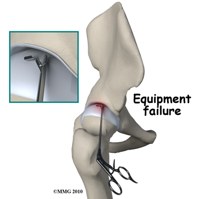 hip_arthroscopy_equipment_failure