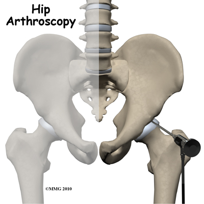 hip_arthroscopy_intro01