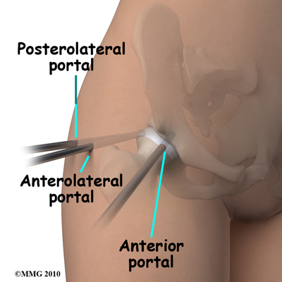 hip_arthroscopy_portals