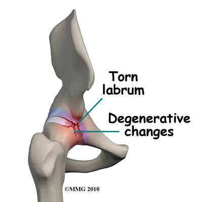hip_arthroscopy_rationale_labral_tear