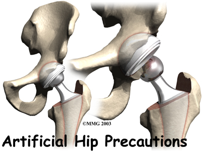 Artificial Hip Dislocation Precautions | Central Orthopedic Group