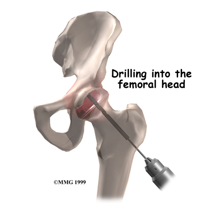hip_avn_treatment01