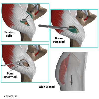 hip_bursectomy_surgery05