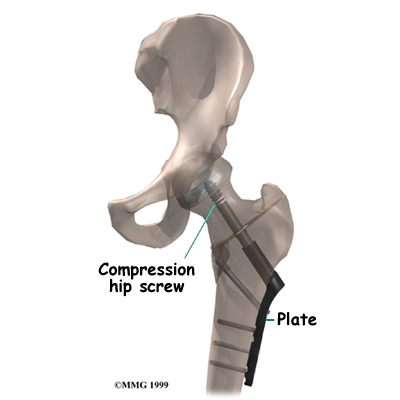 Compression Fixation for a Fractured Hip | LI Orthopedist