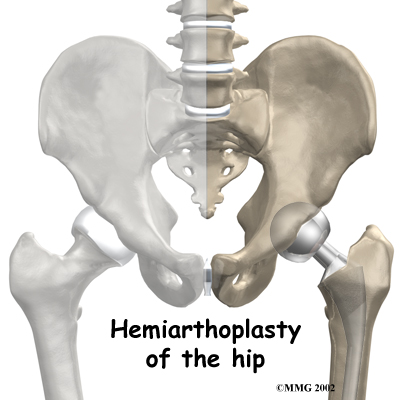 hip_hemiarth_intro01