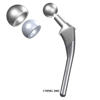 hip_hemiarth_surgery01a