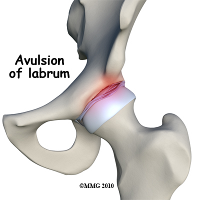 hip_labral_tear_avulsion