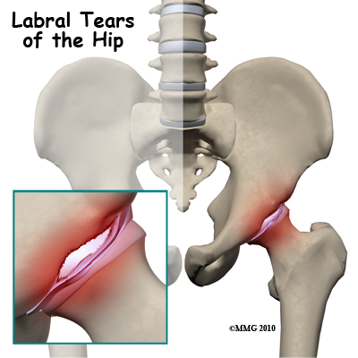 hip_labral_tear_intro01