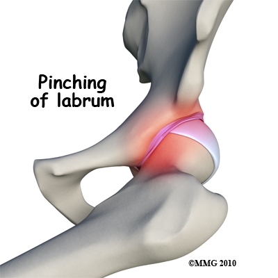 hip_labral_tear_causes01