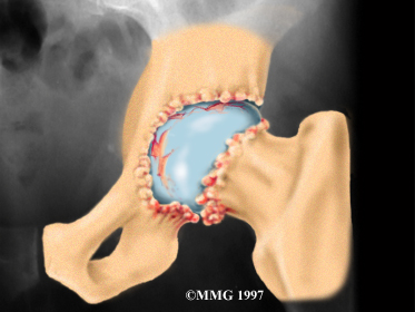 hip_oa_diagnosis01