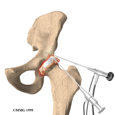 hip_oa_surgery01