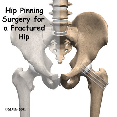 hip_pinning_intro01