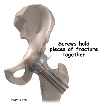 hip_pinning_procedure01