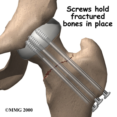hip_stressfx_surgery01