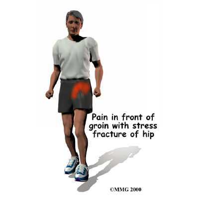 hip_stressfx_symptom01